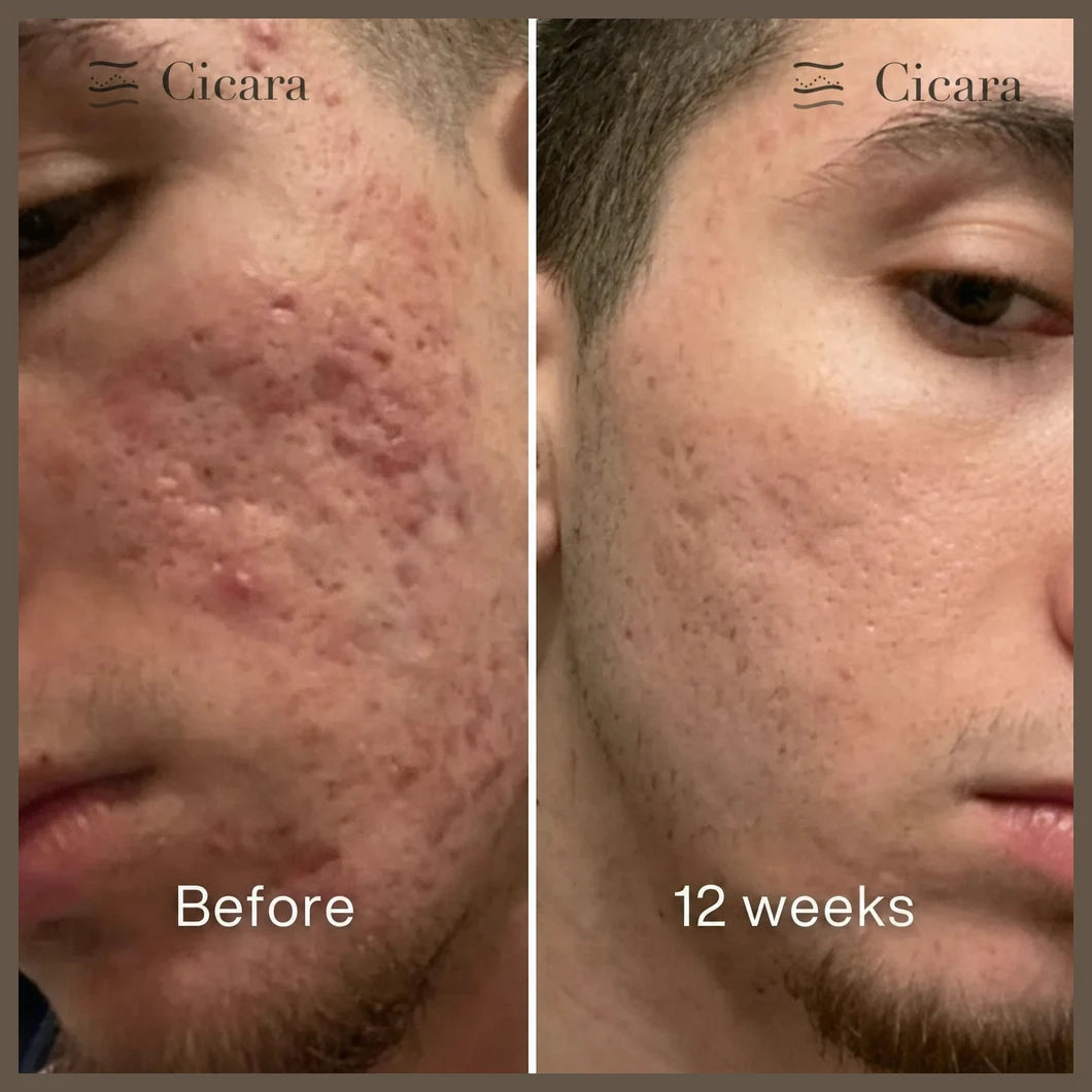 Cicara scar recovery system